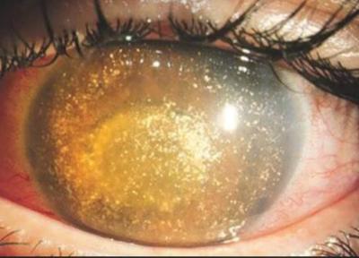 بیماری هیالوز ستاره ای (AH) باعث می گردد چشمان انسان مانند کهکشان به نظر برسند